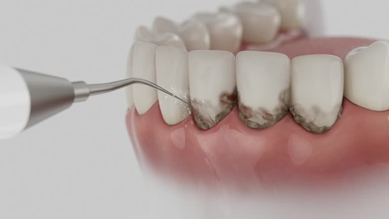 Trusted Wisdom Tooth Removal service in El Cajon, CA - Dentist Open Now